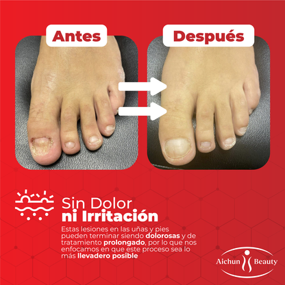 Crema para eliminar hongos en los pies - AichunBeauty™