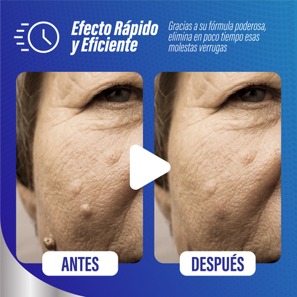 Crema removedora de verrugas - WartOff™